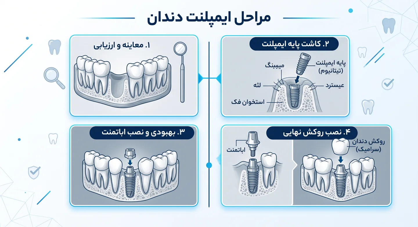 کاشت دندان قسطی؛ راهنمای انتخاب مرکز مناسب و بررسی هزینهها